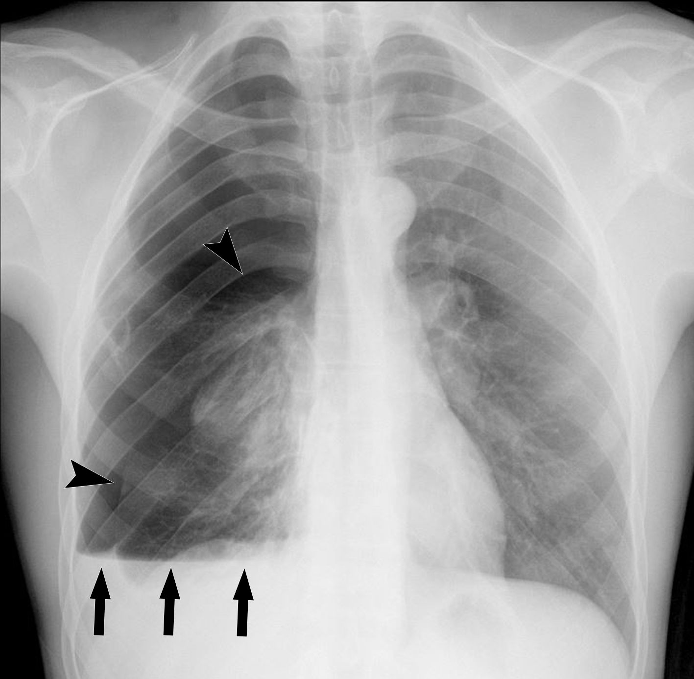 Chapitre 91 Épanchement pleural liquidien Livre rouge CERF — free download